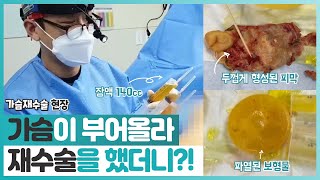 한쪽가슴이 부어올라 재수술을 했더니 상태가?!