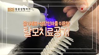 탈모의 근본적인 해결책! 줄기세포+성장인자를 이용한 탈모치료