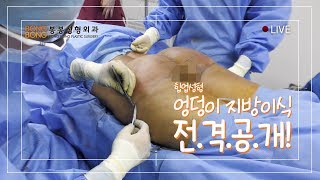 봉봉성형외과 엉덩이지방이식 수술과정 전격공개