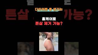 임신, 다이어트 튼살, 해결방법 고민이라면?