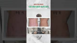 흘러내리는 처진뱃살 운동으로 안될 땐
