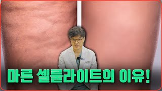 체형과 상관없는 셀룰라이트, 원인과 해결방법