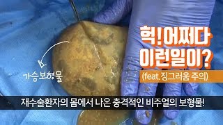 재수술환자의 가슴에서 나온 충격적인 비주얼의 보형물!