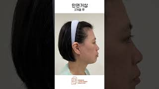안면거상 수술 전과 후, 믿을 수 없는 변화!