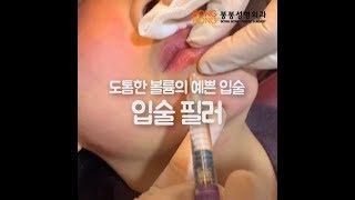 도톰한 입술, 봉봉 쁘띠 클리닉 입술필러