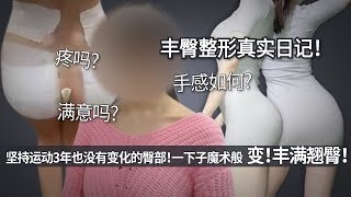 选对了医院，在棒棒家做了丰臀整形！脂肪加假体复合性丰臀整形真实日记