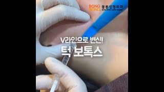 V라인으로 변신! 턱보톡스