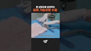직접 보고 확인하는 가슴 성형 수술 과정 A to Z
