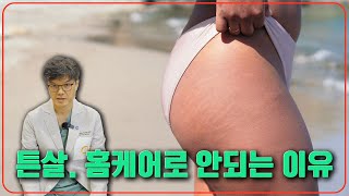 튼살, 놔두면 평생? 해결 방법 총정리!