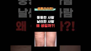 셀룰라이트 왜 생길까? 진짜 원인 공개!