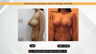 봉봉성형외과 하이브리드 가슴성형편
