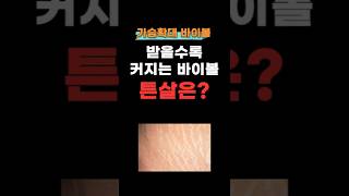 바이볼가슴성형도 계속하면 튼살이 생길까?