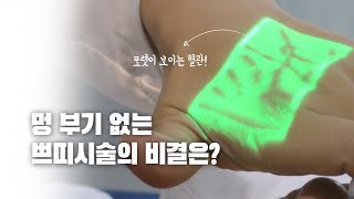 “봉봉 쁘띠성형 멍, 부기 없는 진짜 이유는?”