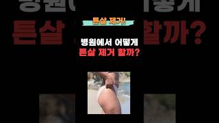 튼살, 홈케어로 안된다면?