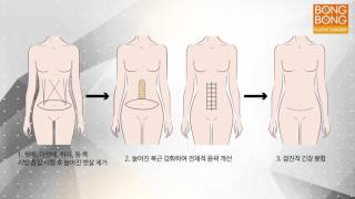 봉봉성형외과 복부성형