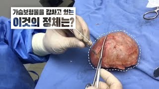 가슴보형물을 감싸고 있는 피막! 그리고 피막완벽제거 피막전절제술!